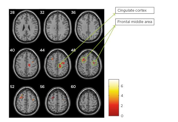 Cambios neuropsicológicos y en el volumen de sustencia gris en pacientes con esclerosis múltiple tras una terapia de rehabilitación cognitiva asistida por ordenador